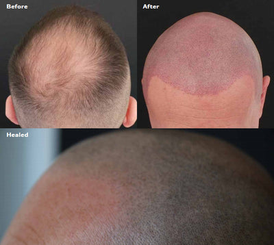 Hair Transplant Scar Types and How To Hide Them