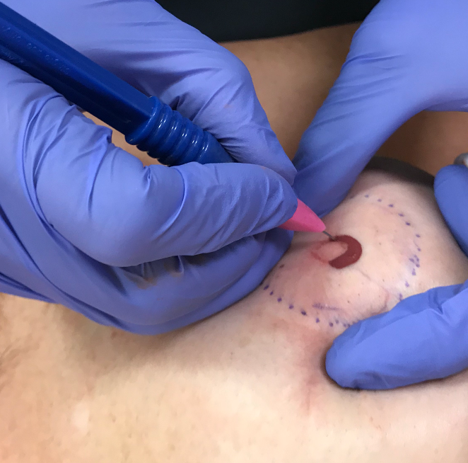 Color Matching • Skin Graft Case | Let's talk color matching! This is a  tricky part of paramedical tattooing, but my Scar Camouflage course helps  eliminate the guesswork. I cover cool and... |